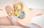 hoergeraet_cochlear