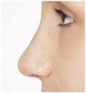 Nasenkorrektur